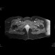 Osteoid osteoma: MRI - Magnetic Resonance Imaging